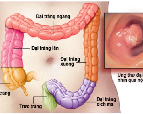 What-is-colon-cancer